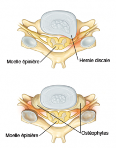 N Vralgie Cervico Brachiale Chirurgie De La Colonne Vert Brale B Ziers