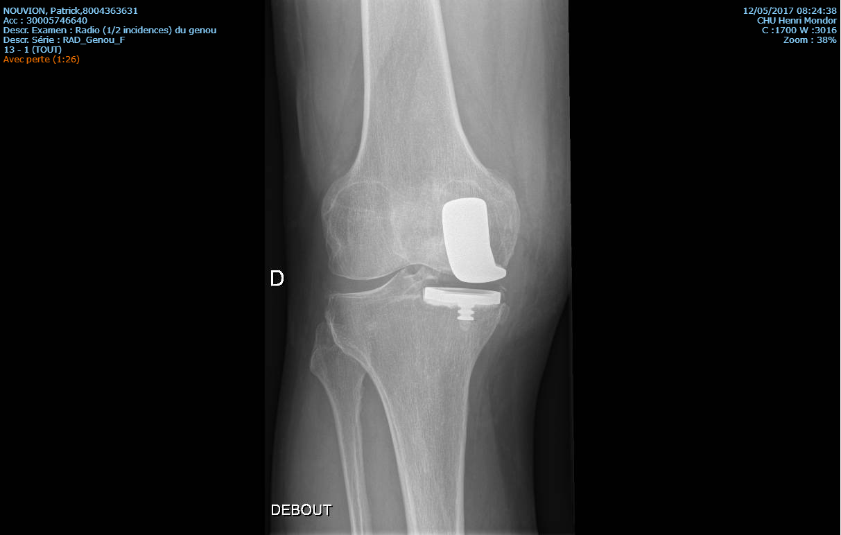 Arthrose du genou Gonarthrose Traitements opérations prothèses