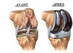 arthrose du genou gonarthrose traitements opérations prothèses