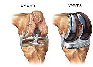 Arthrose du genou - Usure du cartilage du genou - Arthrolink