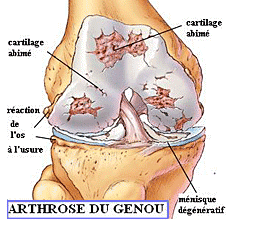 L'arthrose du genou - Laboratoire Dissolvurol