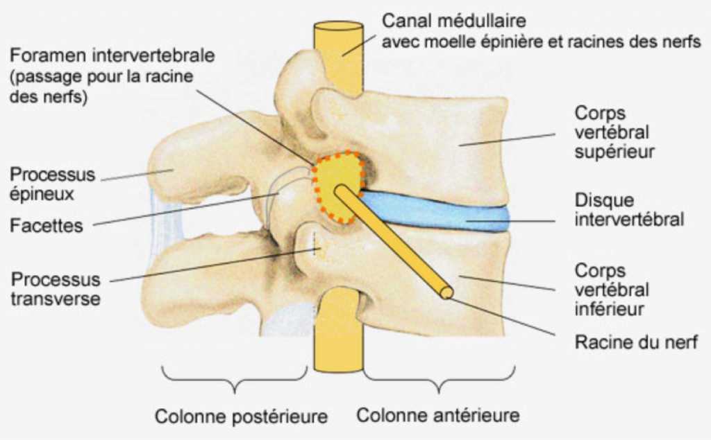 Canal Cervical Etroit Chirurgie Orthop Dique