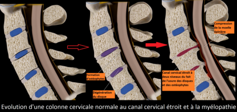 Canal Cervical Troit Chirurgie Orthop Dique