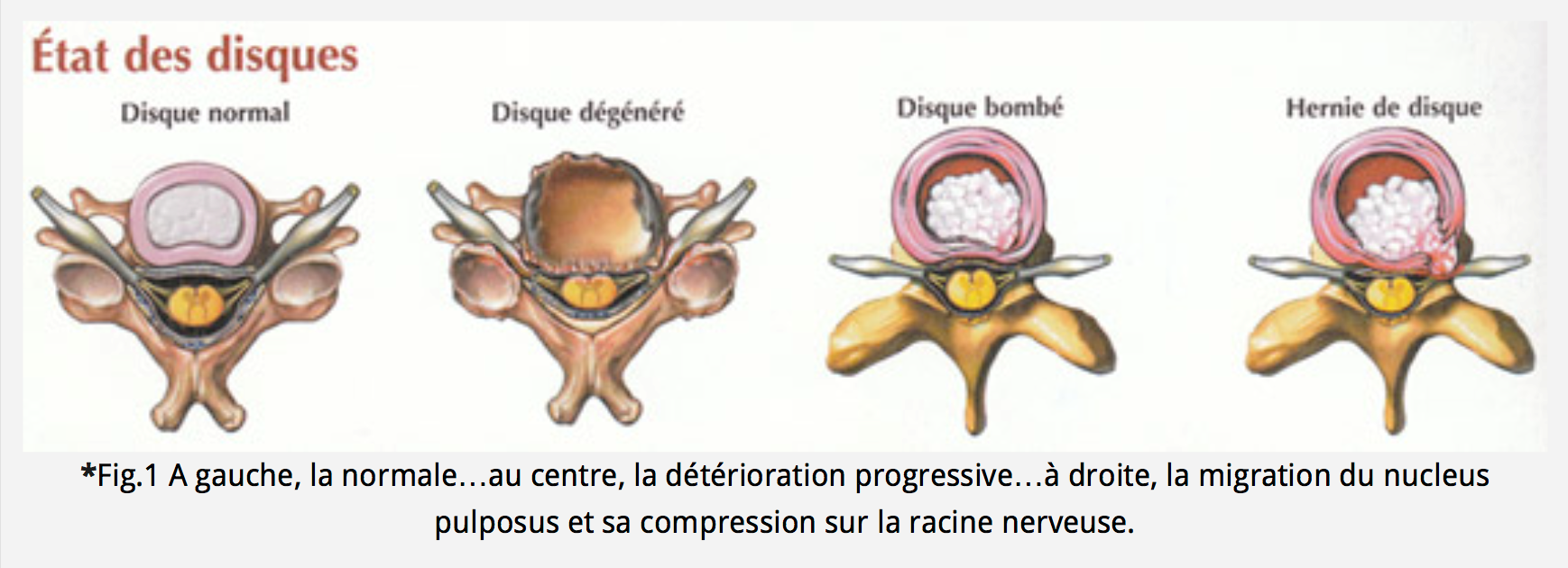 Canal cervical étroit Chirurgie Orthopédique