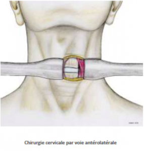 Canal cervical étroit Chirurgie Orthopédique