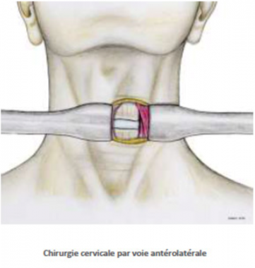 Canal Cervical Troit Chirurgie Orthop Dique