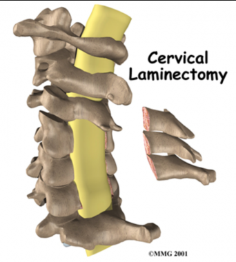 Canal cervical étroit Chirurgie Orthopédique